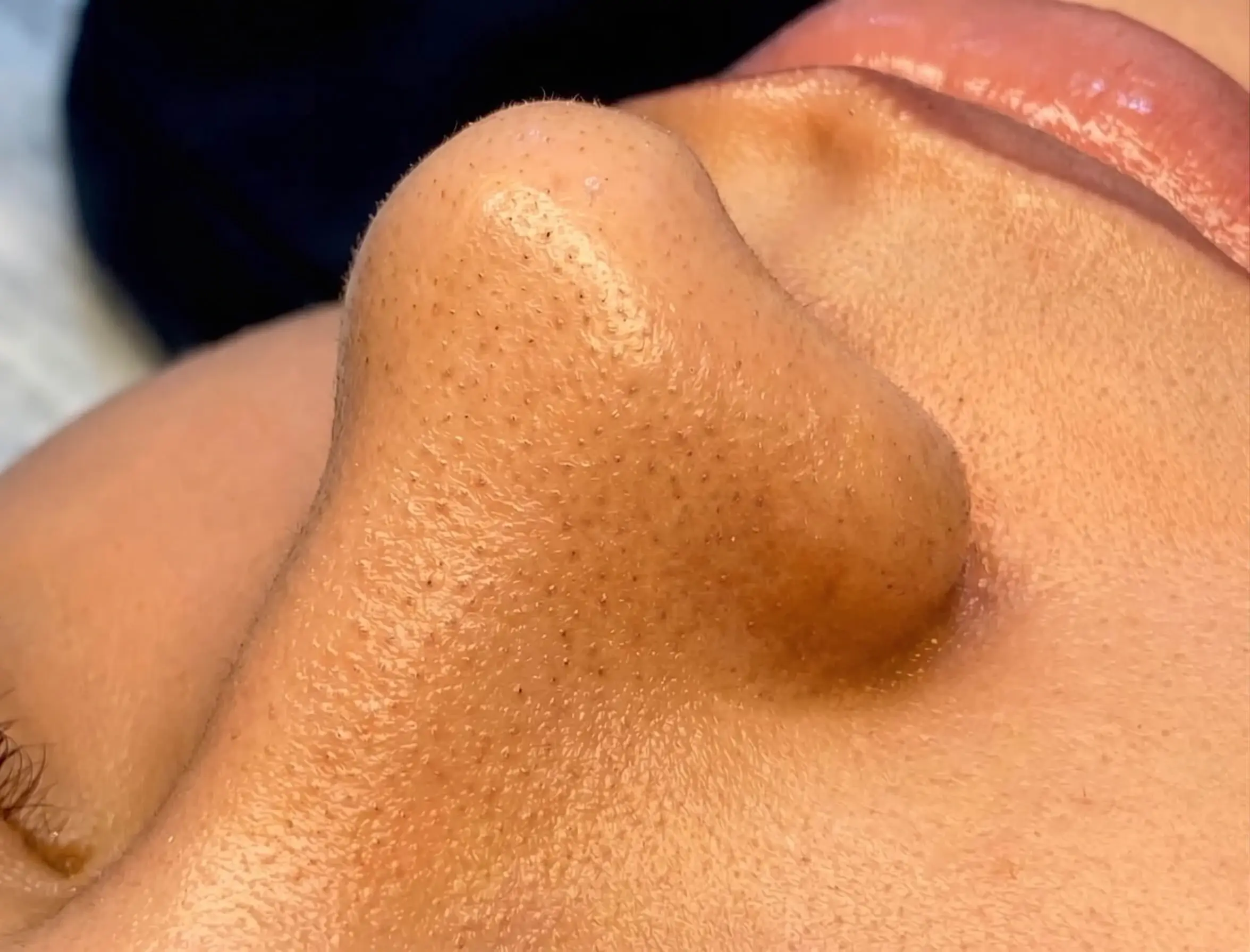 Avant Hydrafacial & Pores Purifiés